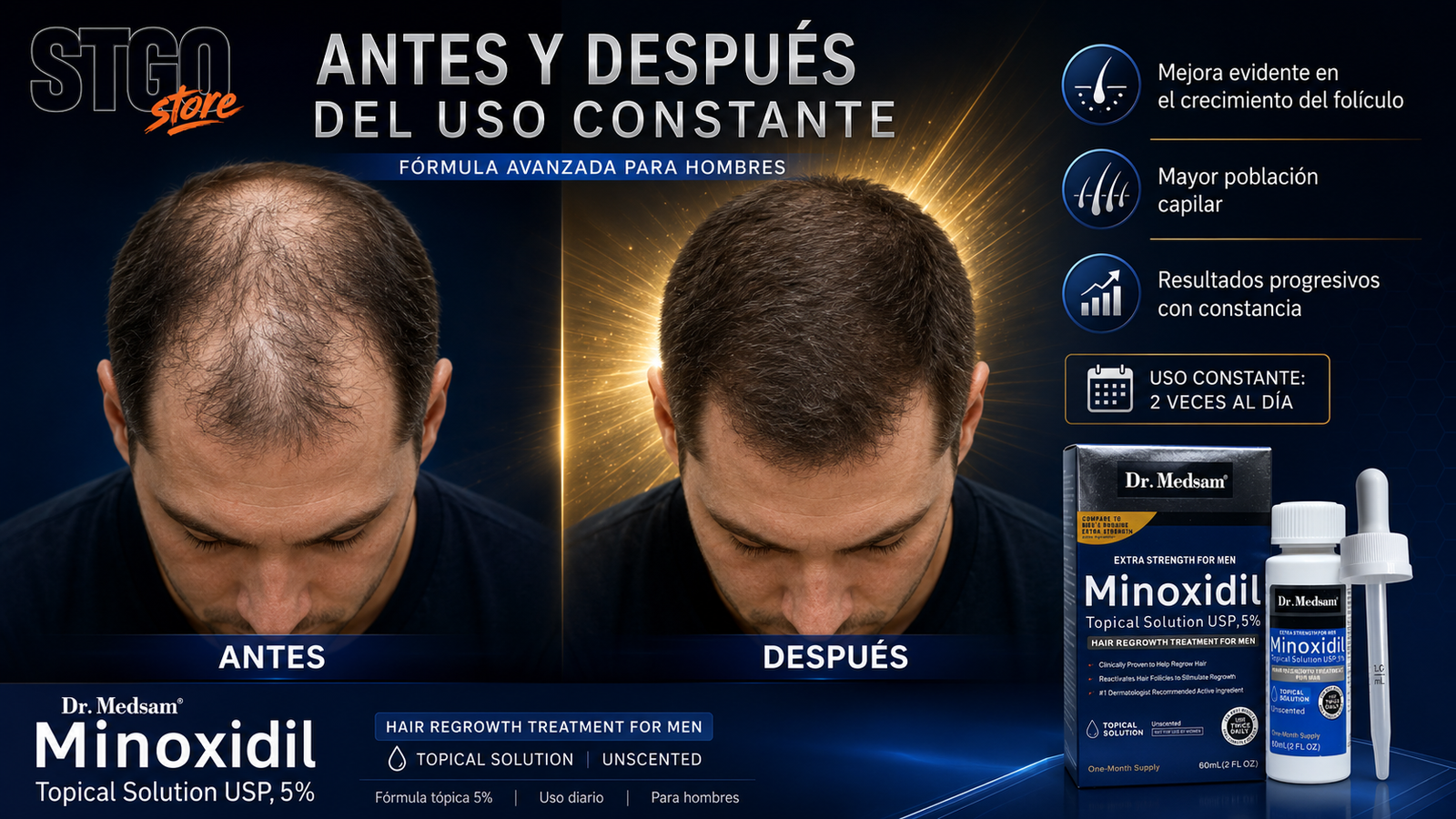 minoxidil-stgostore